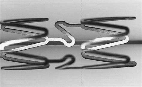 nitinol for stent implantation